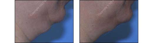 Before and After Hair Removal Photos