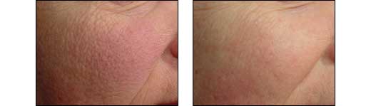 Before and After Redness Photos