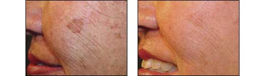 Before and After Sun Spot Photos