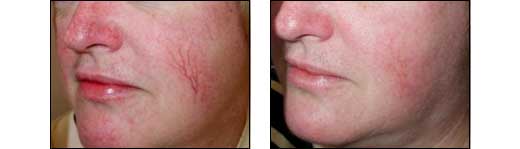 Before and After Redness Photos